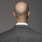 Forget spray-on hair, or those unsightly plugs, scientists believe human stem cells are the final answer to baldness.