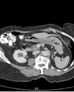 A CT scan of a 76-year-old woman's stomach shows the outline of a pen that was lodged there for 25 years.