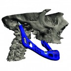 A digital rendering of a face with the lower jaw implant: The implant was made out of titanium powder that was heated and fused together by a laser 3D printer.