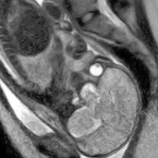 The baby waits in the birth canal just before being welcomed into the world.