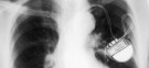 A pacemaker in an X-rayed chest: The life-saving device may be vulnerable to hackers.